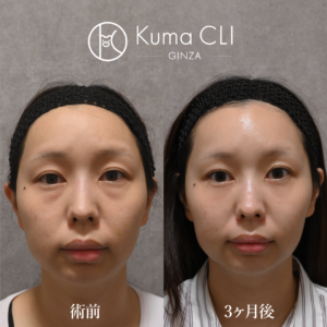 裏evoリフト法＋ナノリッチ